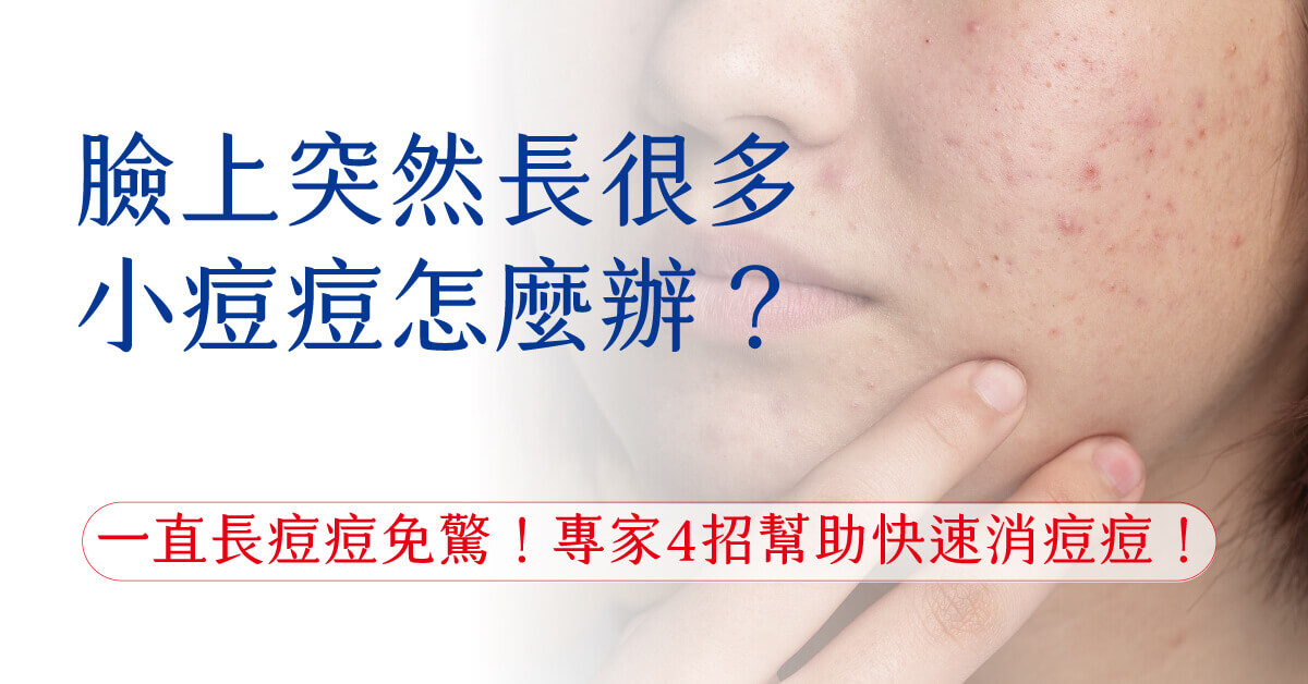 臉上突然長很多小痘痘怎麼辦？一直長痘痘免驚！專家4招幫助快速消痘痘！